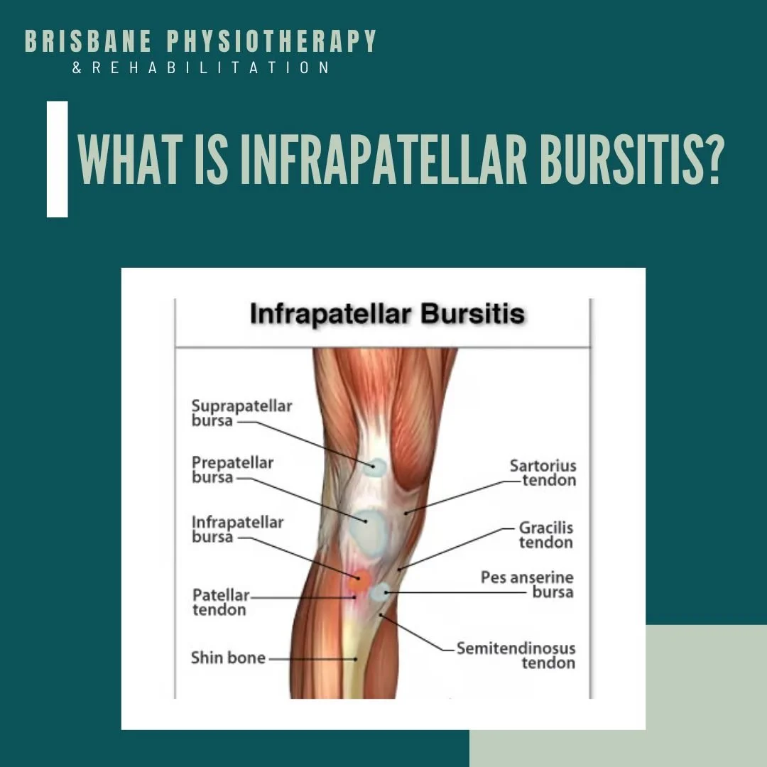 What is Infrapatellar Bursitis Brisbane Physiotherapy